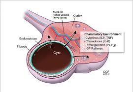 Endometriotic cyst