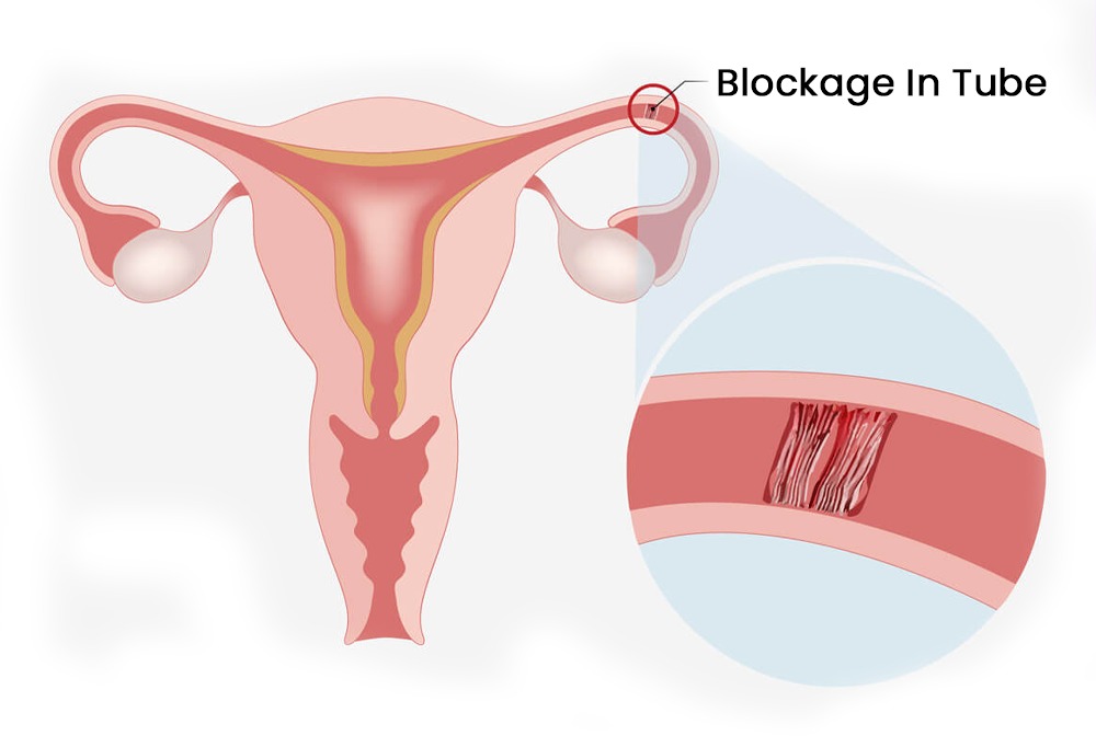 blocked or damaged fallopian tube diagram