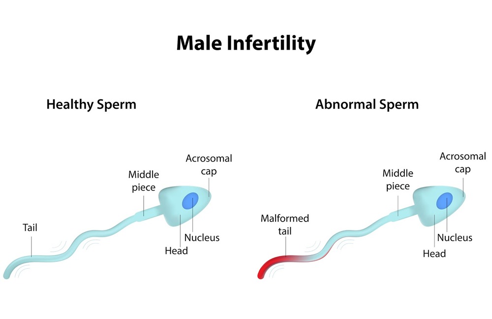 Male infertility diagram