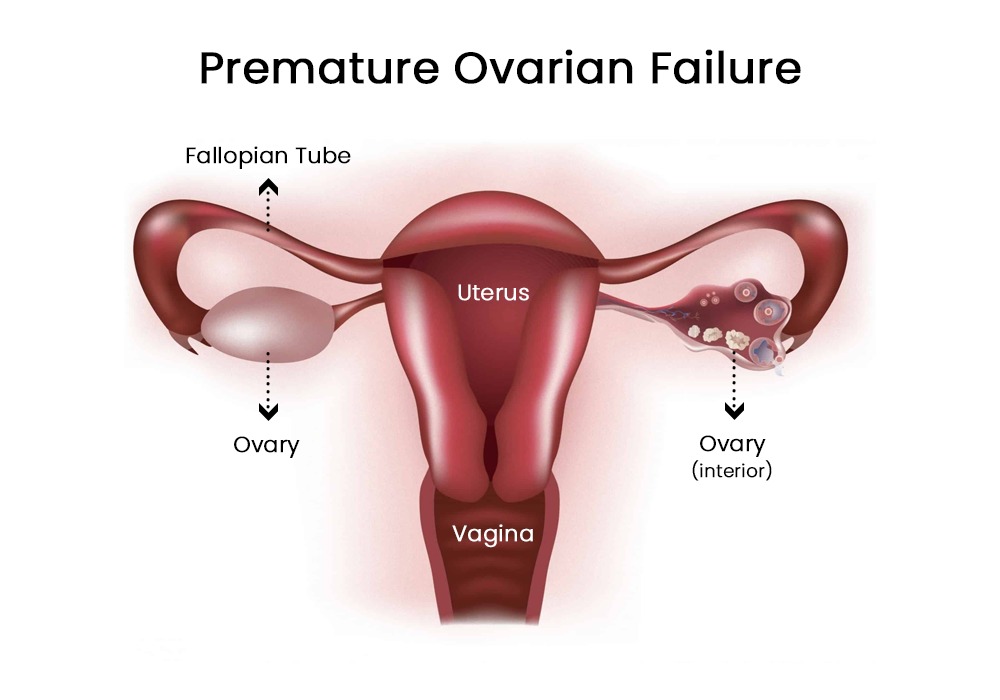 Premature ovarian failure diagram