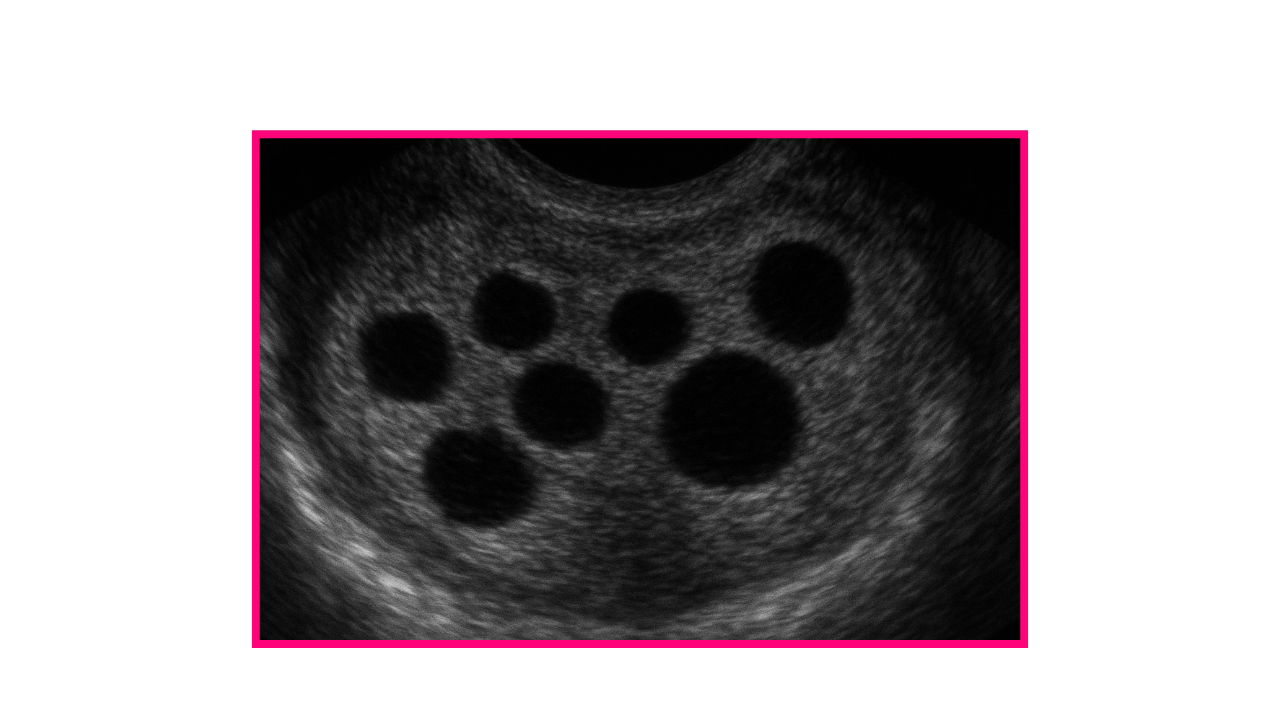 How Many Follicles Are Required for IVF?